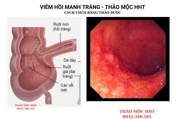 "viem hoi trang"