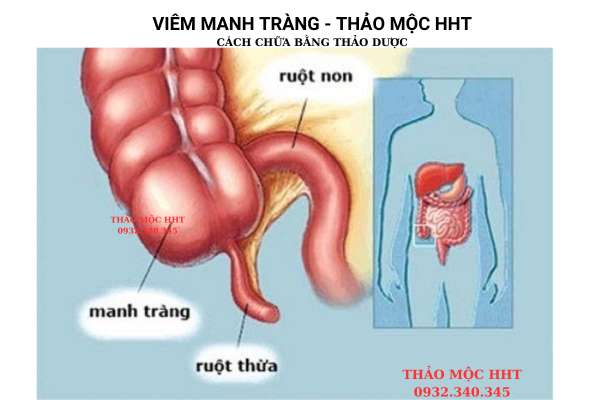 _images/viem-manh-trang-la-gi.jpg