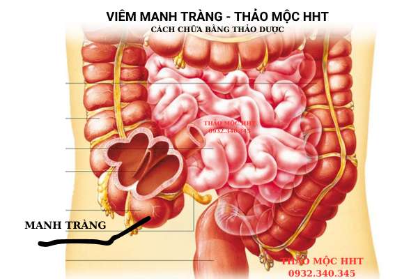 "tong quan ve viem manh trang"